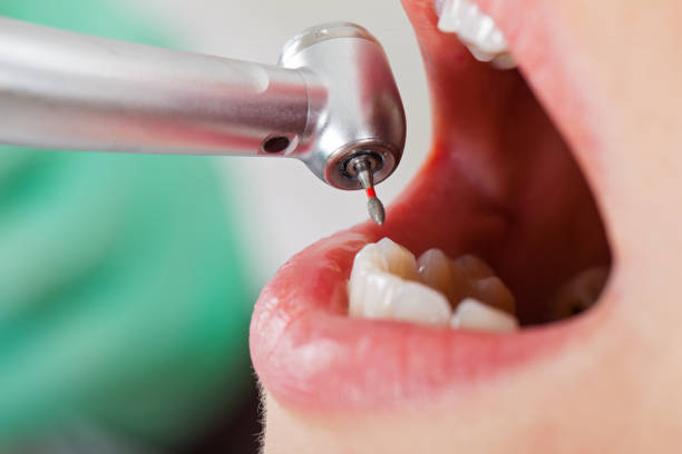 Best Emergency Root Canal Treatment in Shullsburg, WI